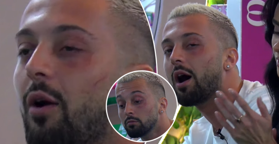 Gjendja e Gjestit një ditë pas sulmit fizik të Jozit në Big Brother VIP Albania 4, që ndodhi në transmetim direkt