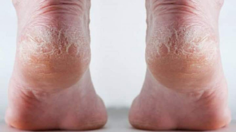 Ja si të shpëtojmë nga të çarat e këmbëve