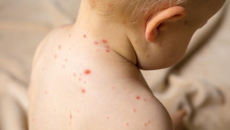 Konfirmohen 12 raste me fruth në 3 muaj në vendin tonë, shumica e fëmijëve të pavaksinuar! Fieri ‘rekord’