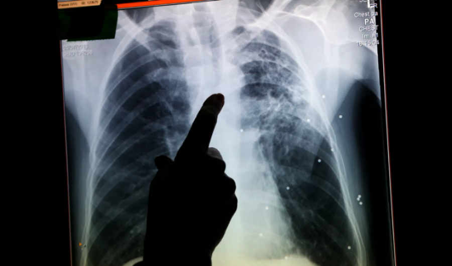 Rritet tuberkulozi në Angli: Një sëmundje e harruar që rikthehet fuqishëm