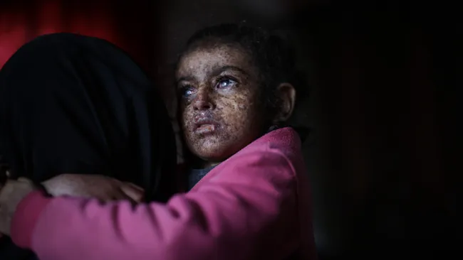 Çfarë është xeroderma pigmentosum? Çrregullimi i rrallë gjenetik që i detyron njerëzit të shmangin dritën e diellit