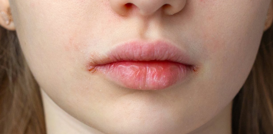 Ja sindroma e heshtur që prek shpesh gratë, ‘sy dhe gojë të thatë’