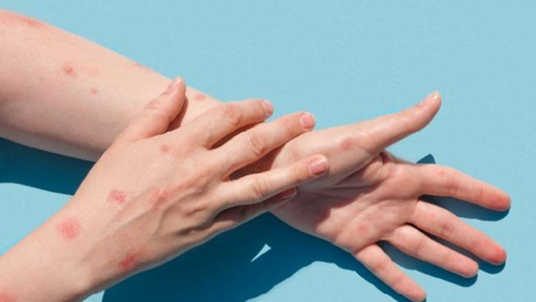 Konfirmohen dy raste të lisë së majmunit në shtetin fqinj, autoritetet thirrje për masa