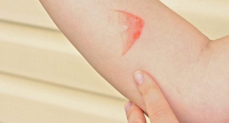 Përse nuk duhet të vendosësh akull mbi lëkurën e djegur