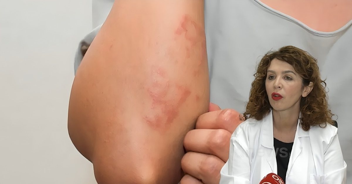 Shenjat e ekzemës/ Mjekët: Njolla të kuqe, kruarje dhe acarim të lëkurës