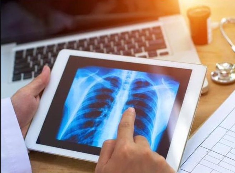 Zbulohet origjina e kancerit të mushkërive që prek kryesisht duhanpirësit