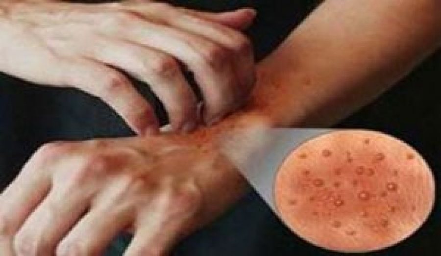 Italia në alarm, zgjebja po përhapet me shpejtësi