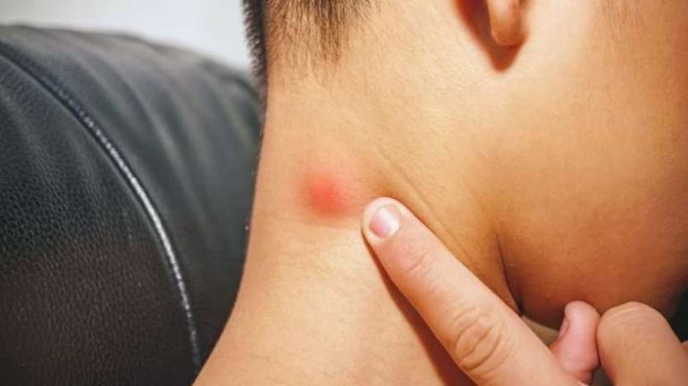 Keni gunga pas veshit dhe qafës? Këto janë trajtimet natyrale që duhet të përdorni