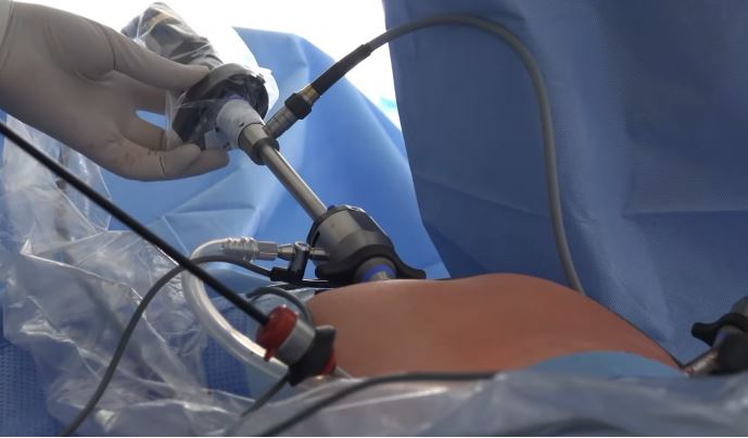 Koçiu: Kryhet ndërhyrja me teknikën Sleeve gastrotektomia laparoskopike, për herë të parë në spitalet publike