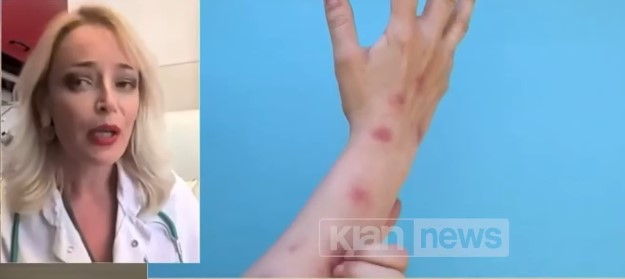 Mjekja shpjegon si përhapet lija e majmunit dhe kush rrezikohet më shumë