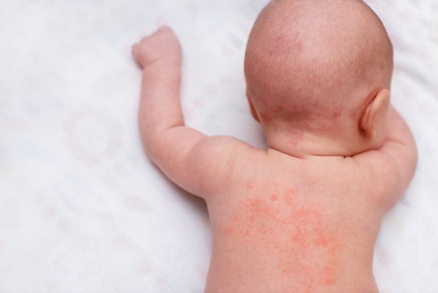 Prindër tregohuni të kujdesshëm, këto 6 simptoma paralajmëruese të meningjitit s’duhet t’i injoroni kurrë