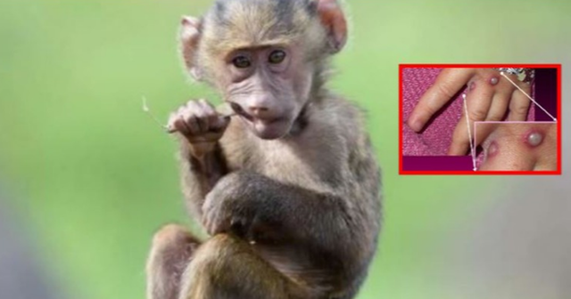 Rasti i parë në Shqipëri! Një 30-vjeçar rezulton i infektuar me lijën e majmunit