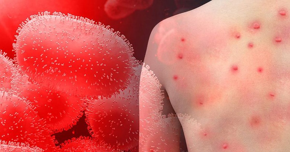 Shfaqet lija e majmunit në Shqipëri! Identifikohet tek një 30-vjeçar