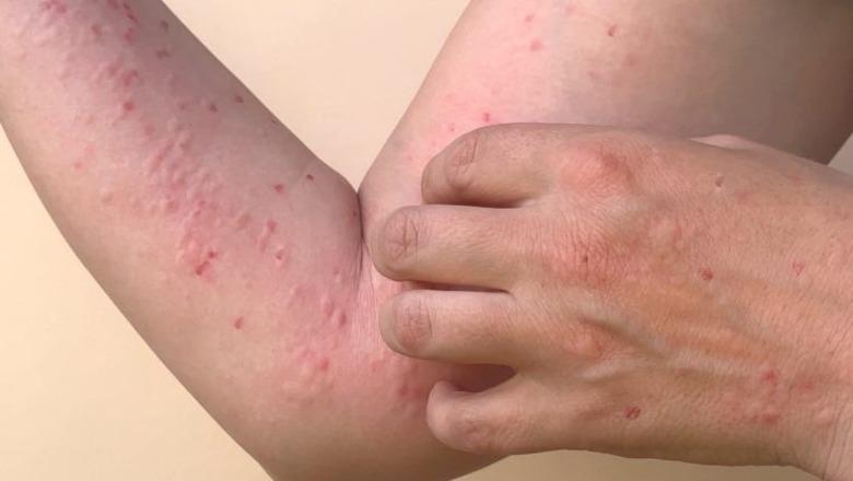 Shfaqet lija e majmunit në Shqipëri, prek një 30-vjeçar