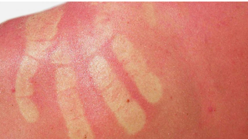 Çfarë duhet të bëni nëse digjeni në plazh