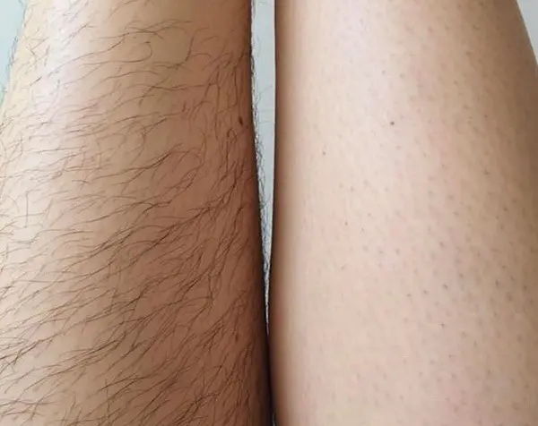 Çfarë sëmundjeje mund t’i tregojë rënia e qimeve në këmbë?