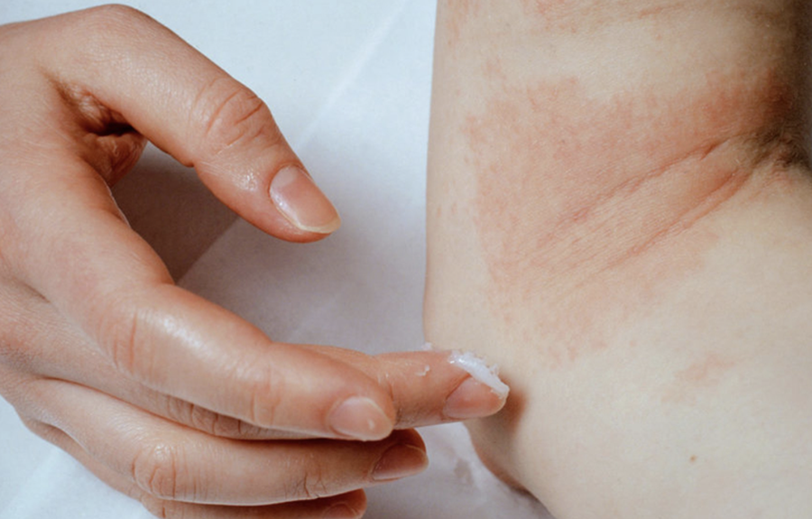 Disa këshilla se si ta përballosh vapën e tmerrshme kur ke ekzemë