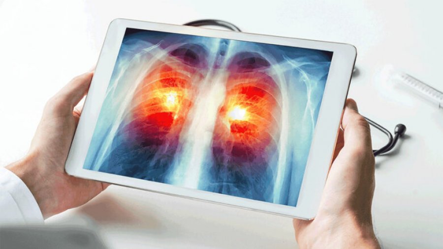 FDA miraton pilulën e parë për kancerin më të përhapur të mushkërive në stad të avancuar