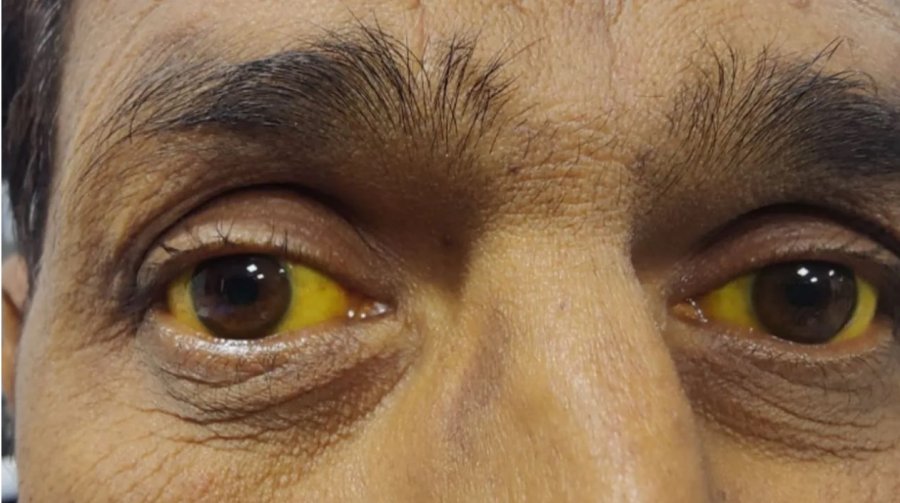 Pesë zakone të përditshme që mund të dëmtojnë në heshtje mëlçinë