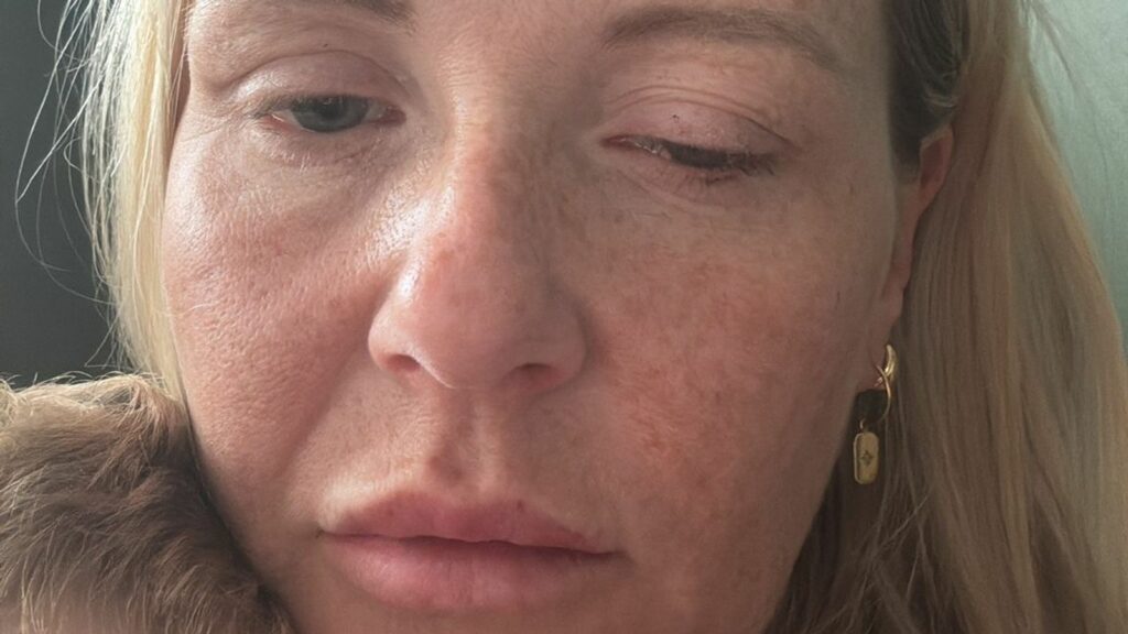 Shpërthim botulizmi në Britani, dhjetëra të prekur nga injeksionet kozmetike ilegale