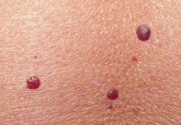 Çfarë i shkakton nishanet e kuq në trup?