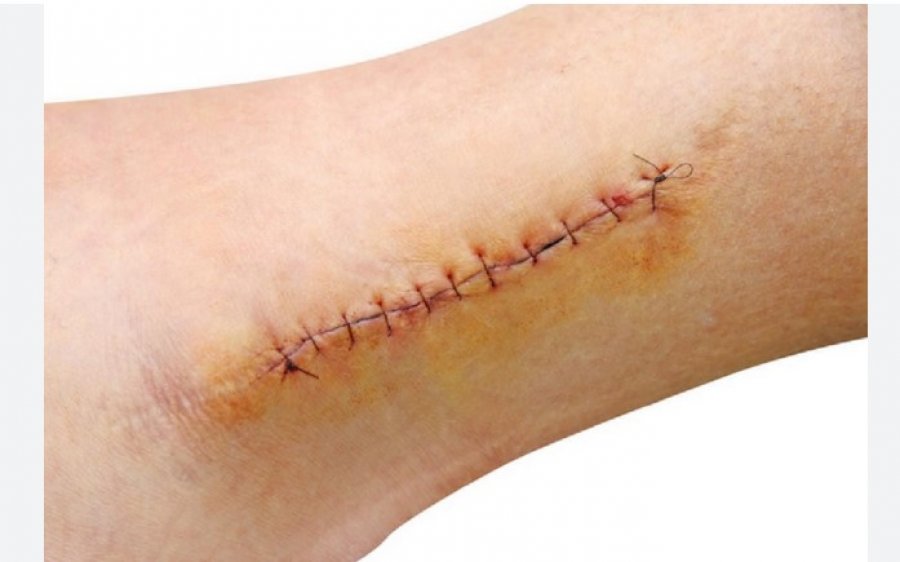 Gjaku menstrual mund të shërojë plagët brenda vetëm 24 orëve?