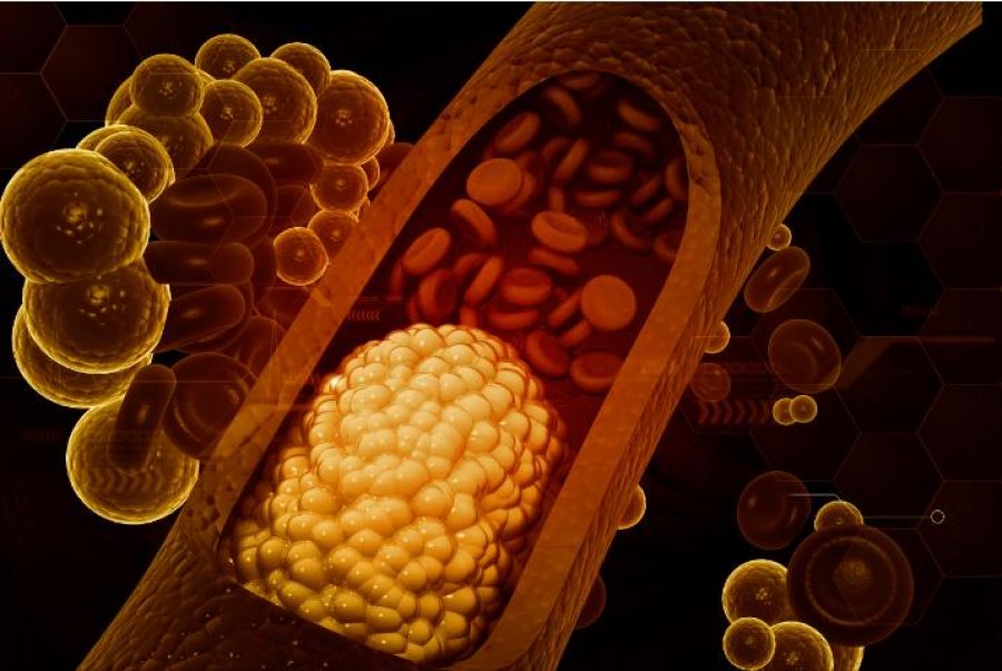 Kolesteroli i lartë mund të jetë i trashëguar. Ja çfarë mund të bëni për këtë.