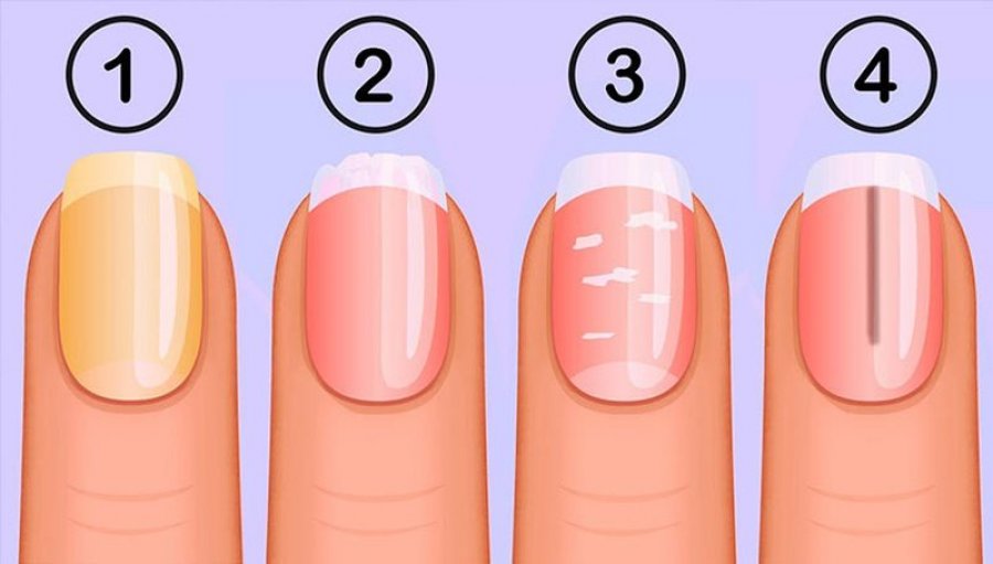 Rastet kur thonjtë janë tregues shëndeti/ mos neglizhoni këto shenja