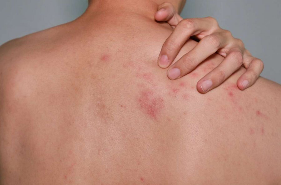 Rrezet e diellit, temperaturat e larta…/ Vera shton rastet me infeksione në lëkurë