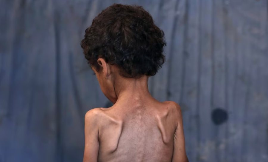 Trondit kreu i “Save the Children”: Fëmijët e uritur në Gaza nuk kanë fuqi as të qajnë!