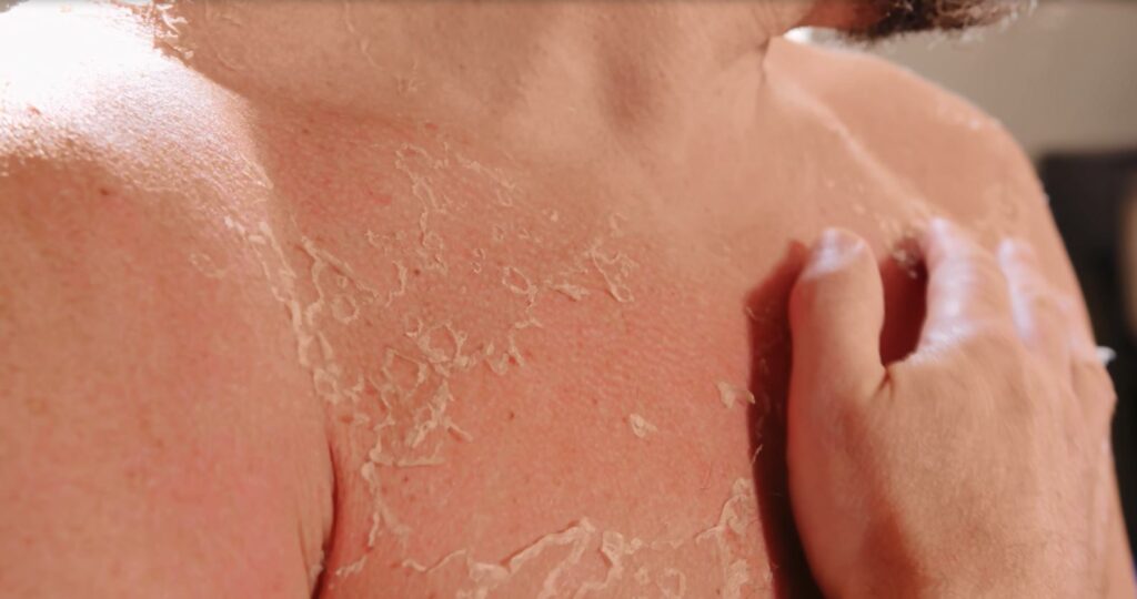 Vera shton rastet me infeksione në lëkurë