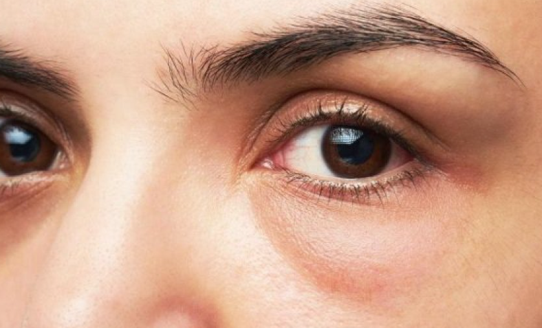 Zgjoheni me sy të fryrë? Ja çfarë mund të sinjalizojë trupi juaj