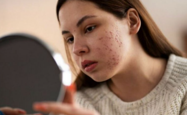 Gjashtë mënyra për t’i parandaluar aknet në trup