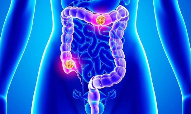 Kanceri i zorrës së trashë, pse është gjithnjë e më i zakonshëm tek personat nën 50 vjeç