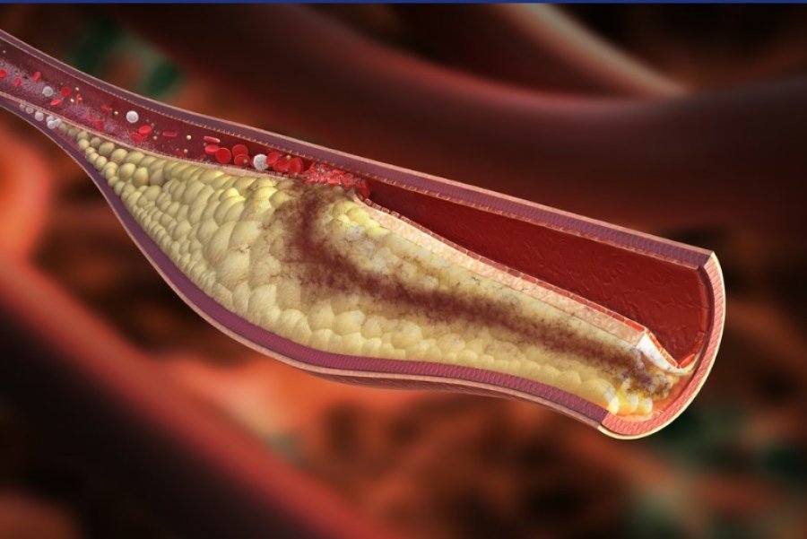 Mjekët paralajmërojnë: Arteriet e bllokuara, një rrezik serioz për shëndetin