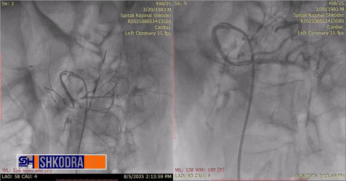 Për herë të parë në Shqipëri, realizohet në Spitalin Rajonal të Shkodrës ndërhyrja komplekse, shpëtohet 43- vjeçari