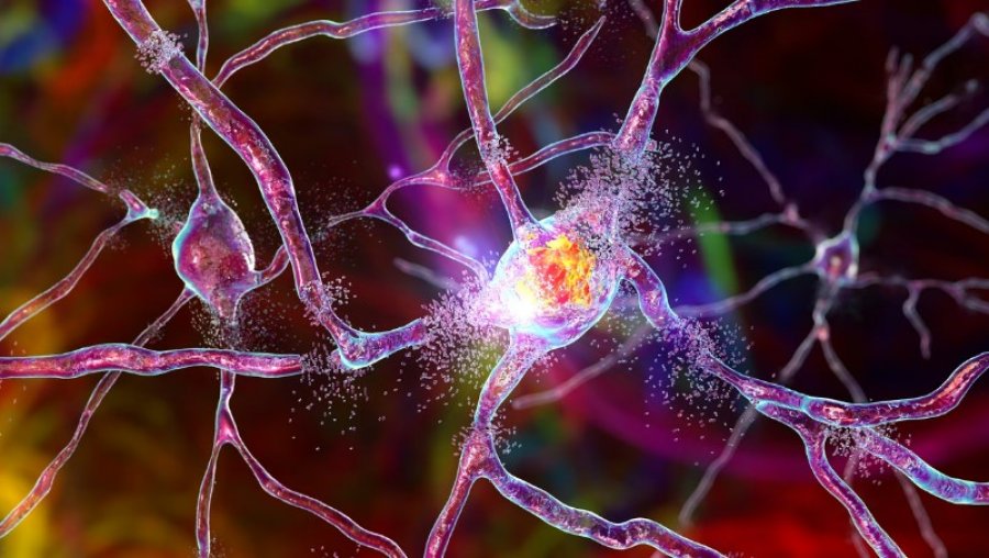 Sëmundja e Huntingtonit shërohet me sukses për herë të parë