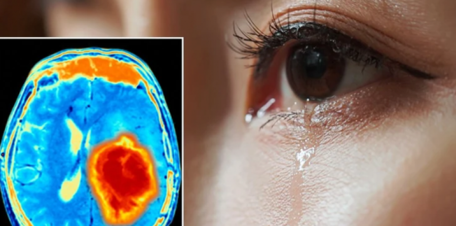 Studimi britanik: Lotët mund të ndihmojnë në zbulimin e tumoreve të trurit