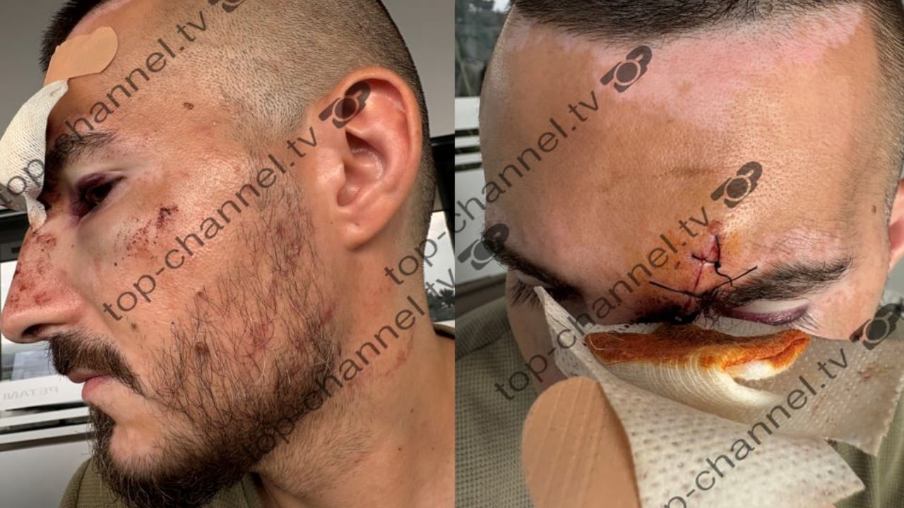 Turisti denoncoi në TCH sulmin dhe grabitjen nga pesë persona! Reagon Policia e Durrësit: Për rastin janë ndaluar dy minorenë