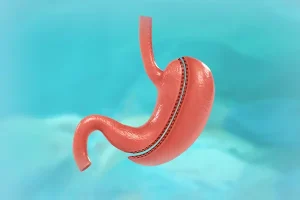 Zvogëlimi i stomakut me kirurgji, ja e vërteta që duhet të dini