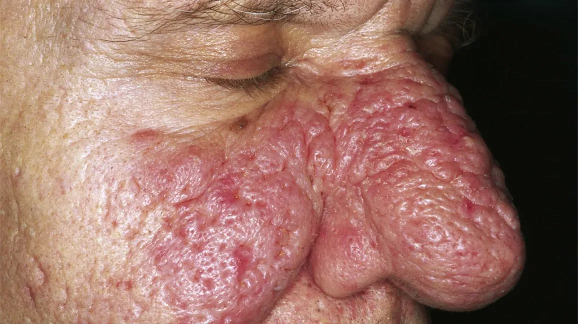 Çfarë është rhinophyma? Sëmundja që e la një burrë pa puthur gruan