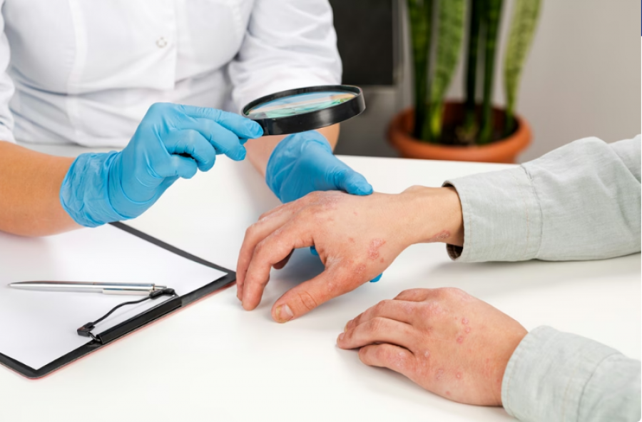 Dita Botërore e Psoriazës: Një thirrje për ndërgjegjësim dhe solidaritet