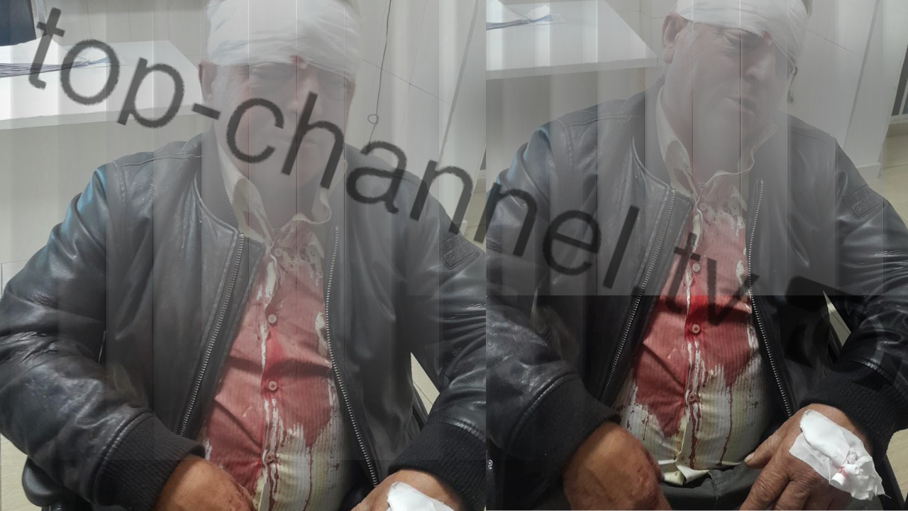 E rëndë në Vlorë/ Dhunohet punonjësi i pastrimit, 70-vjeçari në reanimacion pas sulmit brutal përballë tregut të “Çoles”