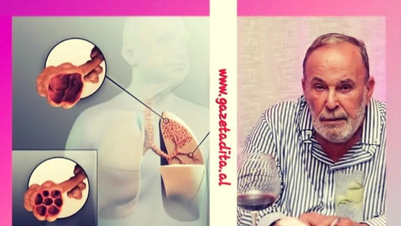 Nga se shkaktohet dhe çfarë është SPOK, sëmundja e pashërueshme që i mori jetën Fatos Nanos