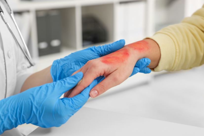 Djegiet/ Si të reagoni menjëherë?