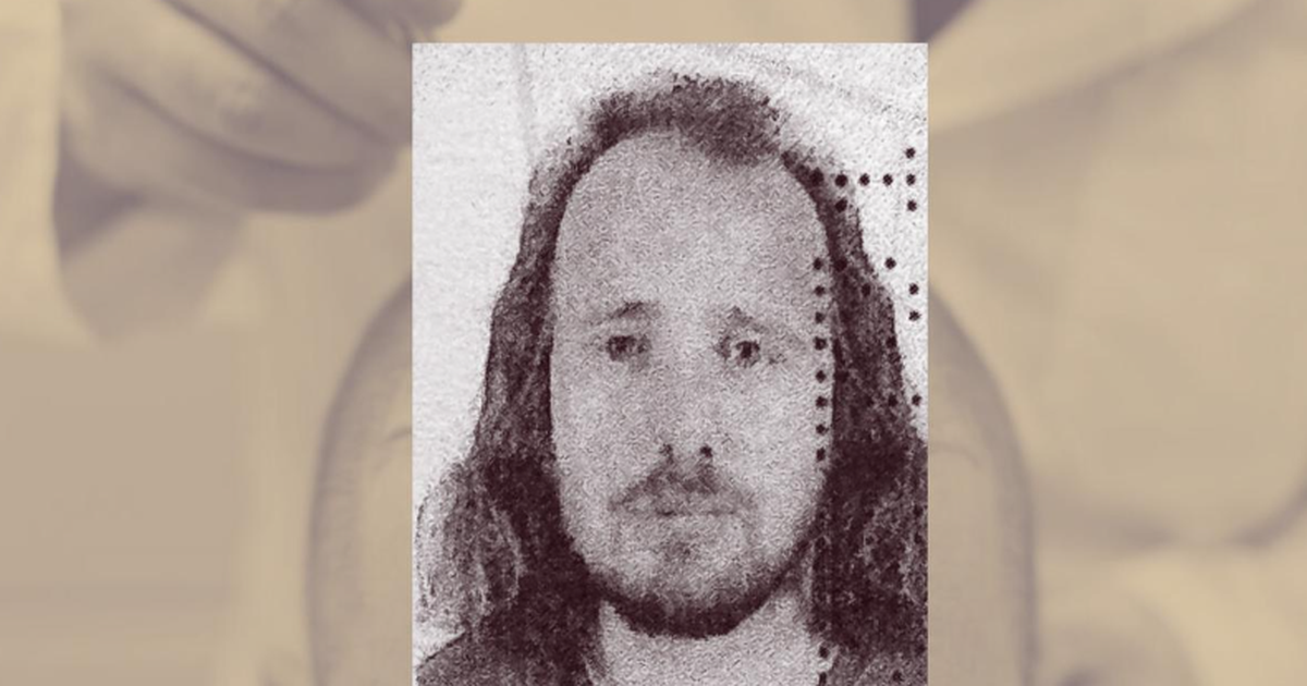 E rëndë në Turqi/ Shqiptari ndërron jetë pas transplantit të flokëve edhe një procedure dentare