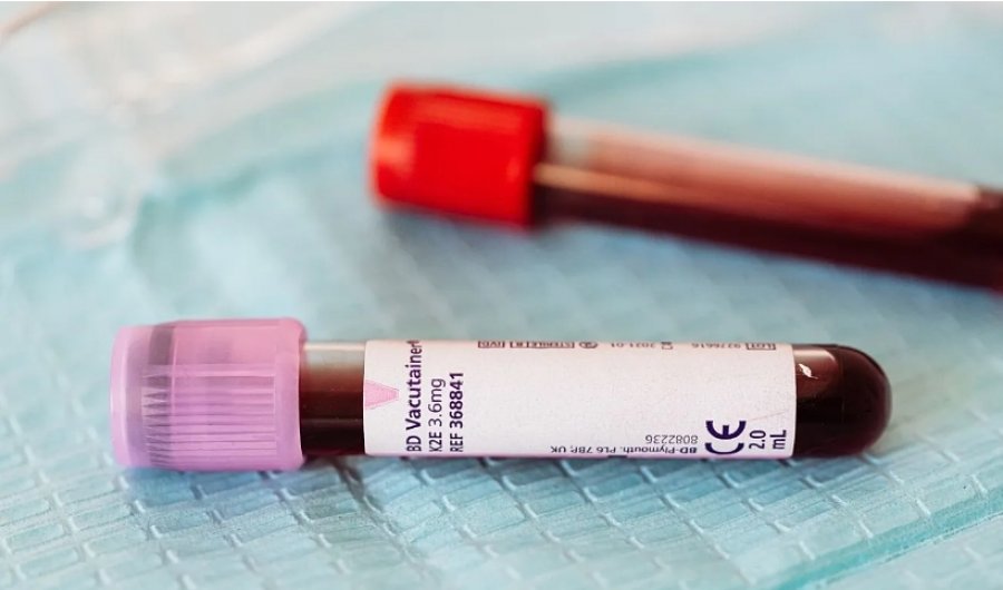 Etiopia konfirmon tre viktima nga virusi vdekjeprurës Marburg