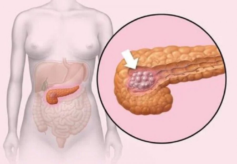 Kanceri i pankreasit, zakoni i rrezikshëm që ‘shkakton’ formën agresive të sëmundjes