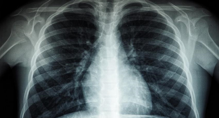 OBSH: Tuberkulozi është sëmundja infektive më vdekjeprurëse në botë, vret 1 milion njerëz çdo vit