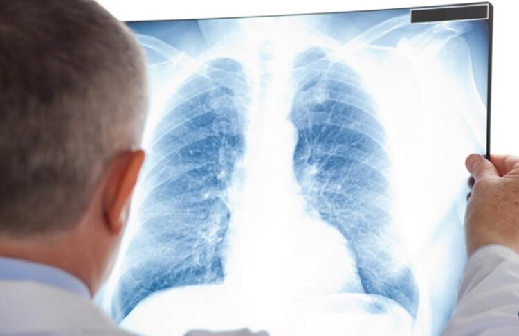 OBSH: Tuberkulozi, sëmundja më vdekjeprurëse infektive në botë për 2024-ën